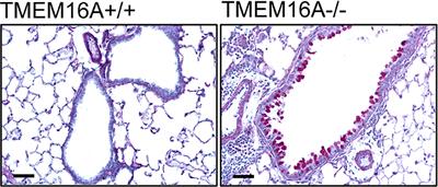 TMEM16A in Cystic Fibrosis: Activating or Inhibiting?